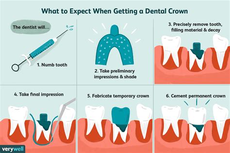 procedure for a dental crown